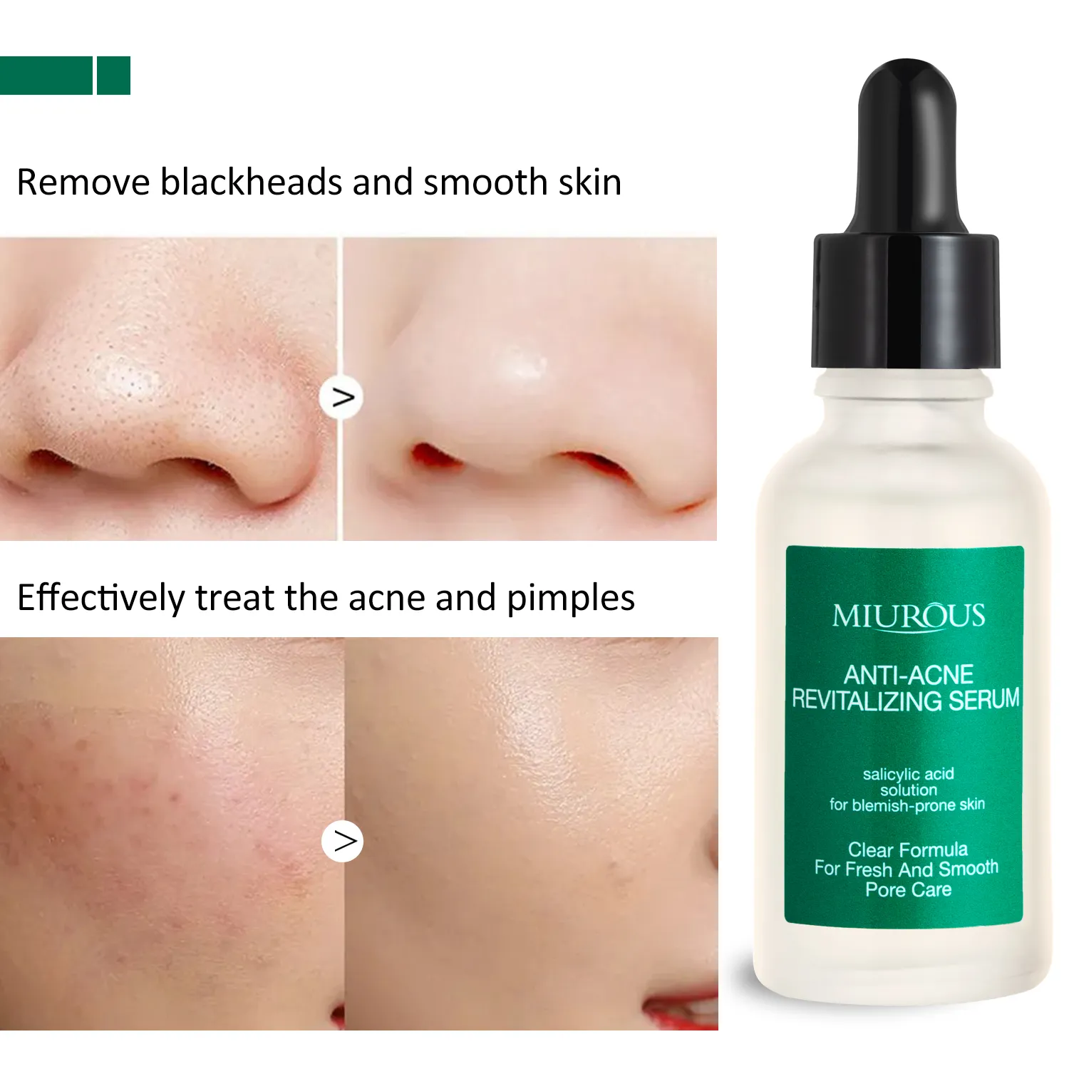 水杨酸祛痘精华 (6)